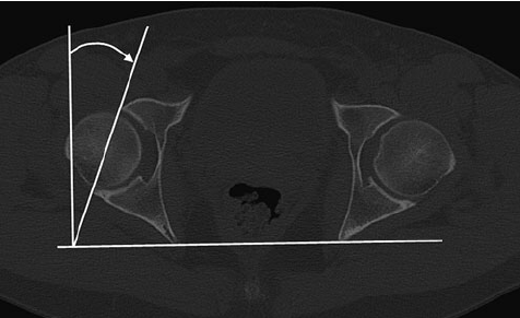 An-axial-CT-image-showing-how-2D-acetabular-version-is-measured-in-this-case-using-slice