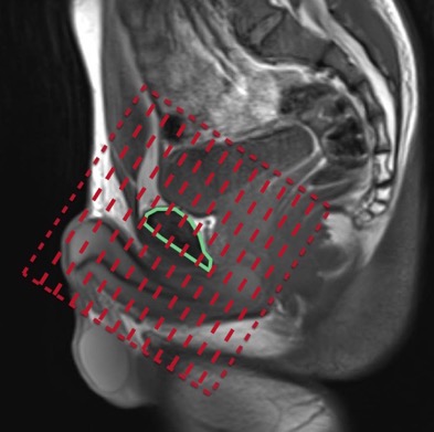 axialobliquefov