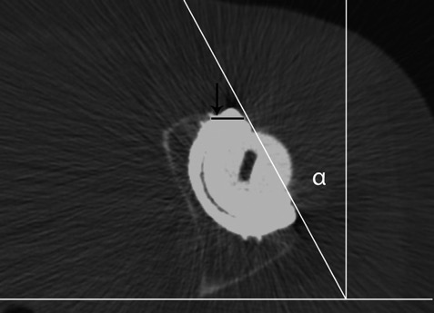 CT-axial-scan-at-the-middle-of-the-femoral-head-The-acetabular-cup-shows-an-overhang-of.ppm