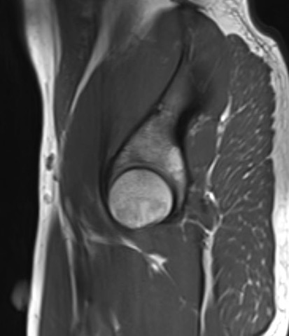 iliopectineal line