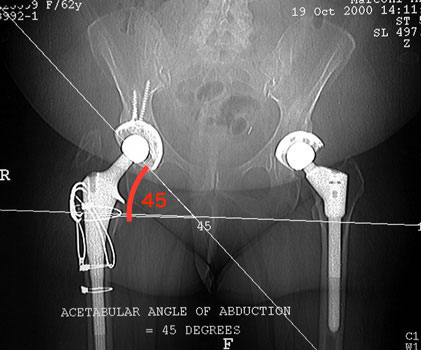 lateralinclincation